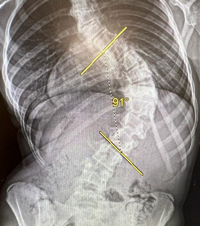 Scoliosis Treatment